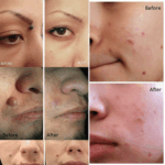 Electric Laser Plasma Pen Mole Removal Dark Spot Remover Skin Wart Tag Tattoo - Image 18