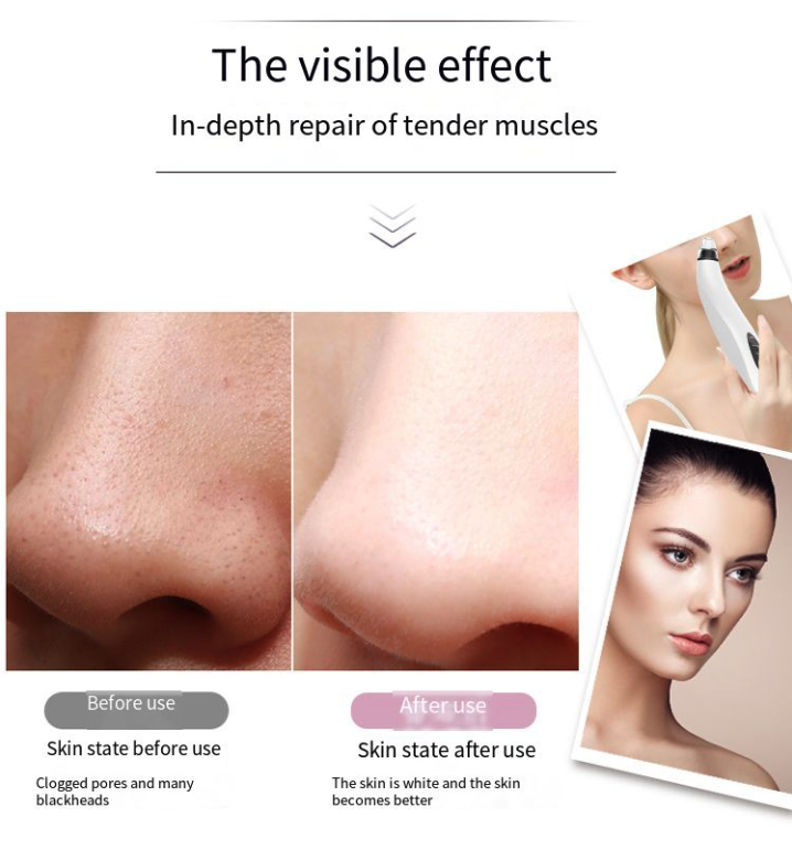 Electric Facial Pore Vacuum Blackhead Remover with 3 Suction Levels and 3 Heads