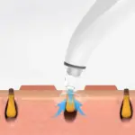 Electric Facial Pore Vacuum Blackhead Remover with 3 Suction Levels and 3 Heads - Image 2